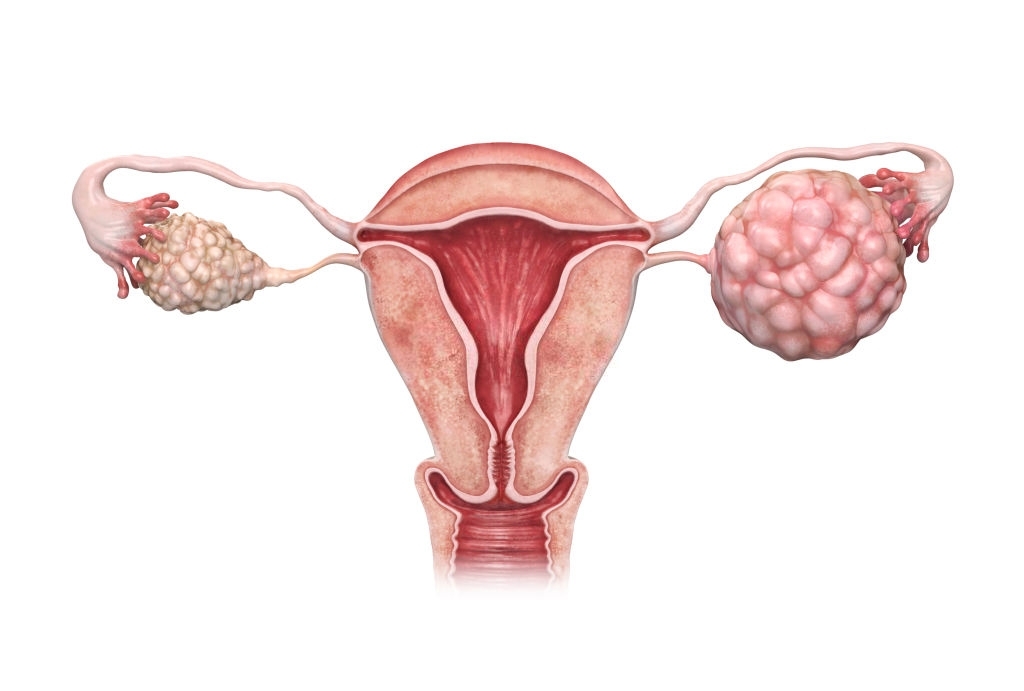 3d rendered illustration of the ovarian cancer.